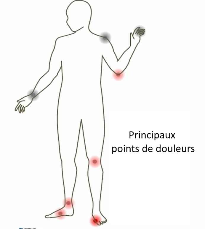 Acide urique élevé : comment savoir si vous l’avez et comment télécharger sans médicaments