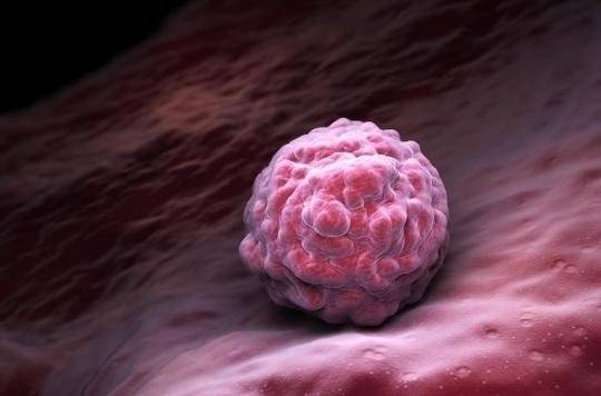 Les chercheurs transplantent des cellules souches dans le cerveau pour traiter la maladie de Parkinson