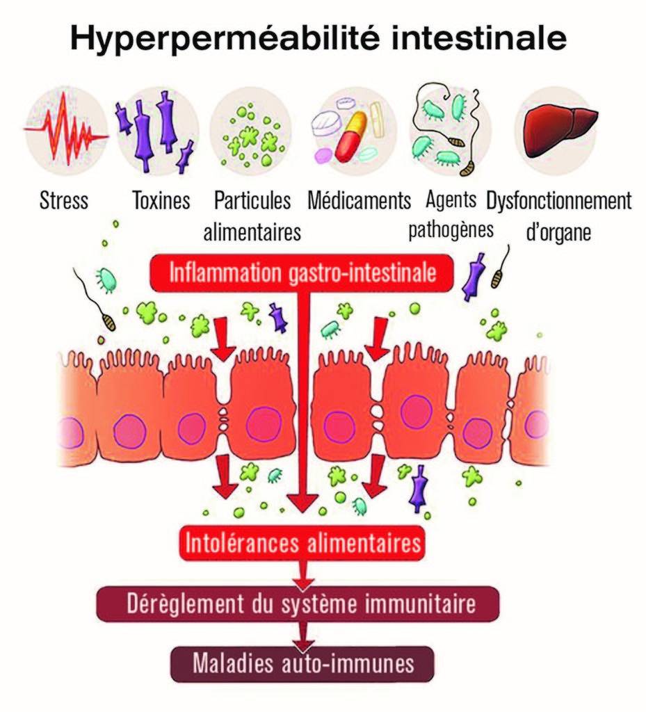 Syndrome de l’intestin de fuite — Syndrome du côlon perméable