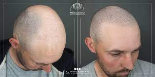 Qu’est-ce que la micropigmentation du cuir chevelu ?