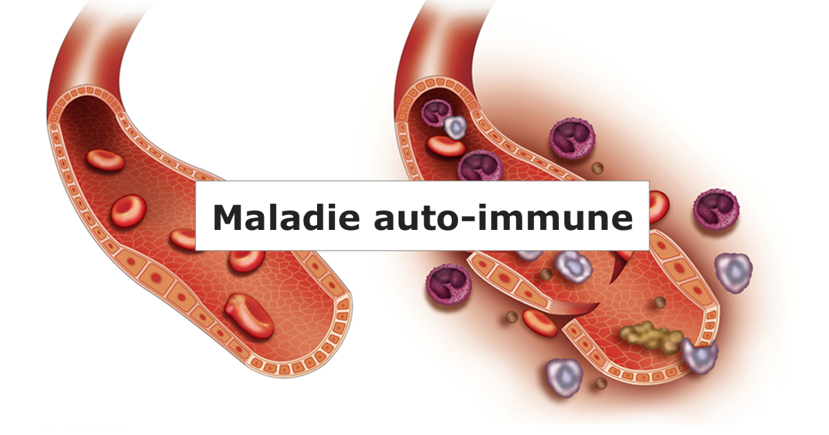 Ce qu'il faut savoir sur la maladie auto-immune